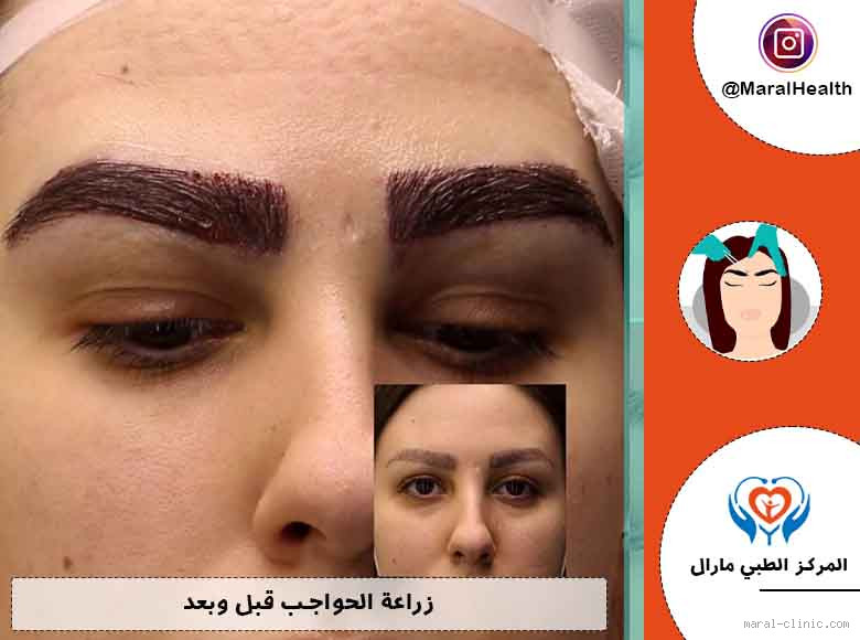 هل تمشيط الحواجب يكثرها؟ حقيقة أم خرافة؟