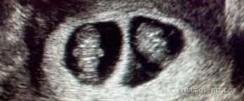 هل يؤثر موت أحد التوائم على الآخر نفسيا؟