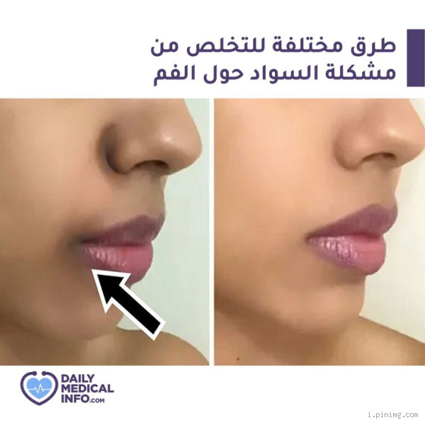 هل العسل يزيل سواد حول الفم؟