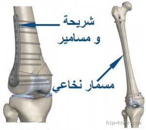 هل الجسم يرفض الشرائح والمسامير أحيانًا؟
