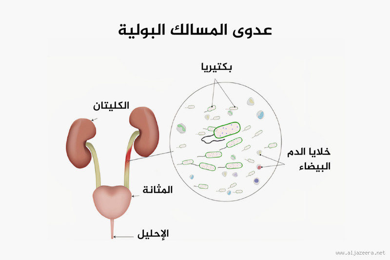 هل التهاب المسالك البولية يسبب سرعة القذف؟