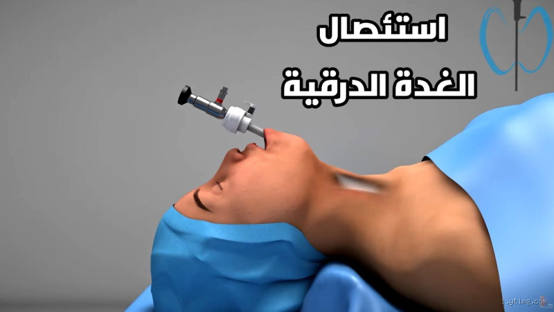 هل عملية الغدة صعبة؟ إليك الحقيقة بدون لف ودوران