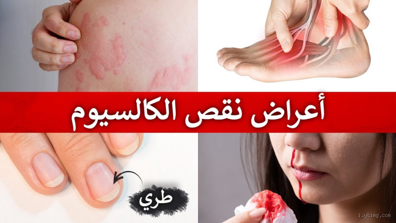 هل نقص الكالسيوم يسبب بقع بيضاء في الجسم؟ تعرف على الحقيقة