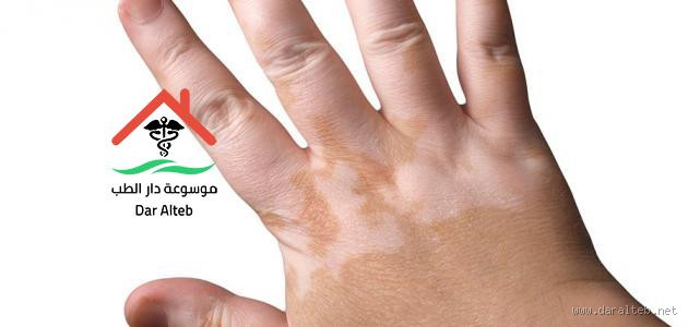 هل قرصه البرص مؤذية؟ كل ما يجب أن تعرفه عن البرص