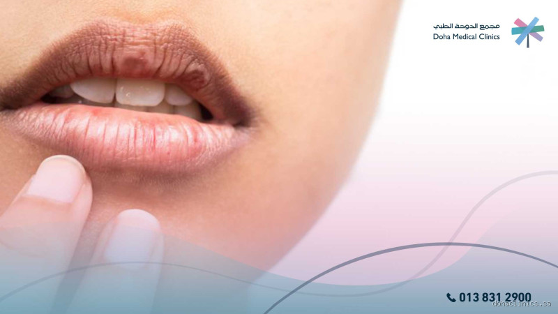 هل يمكن أن يسبب الارتجاع جفاف الفم؟ كل ما يجب أن تعرفه