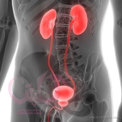 هل يتبول مريض الغسيل الكلوي؟