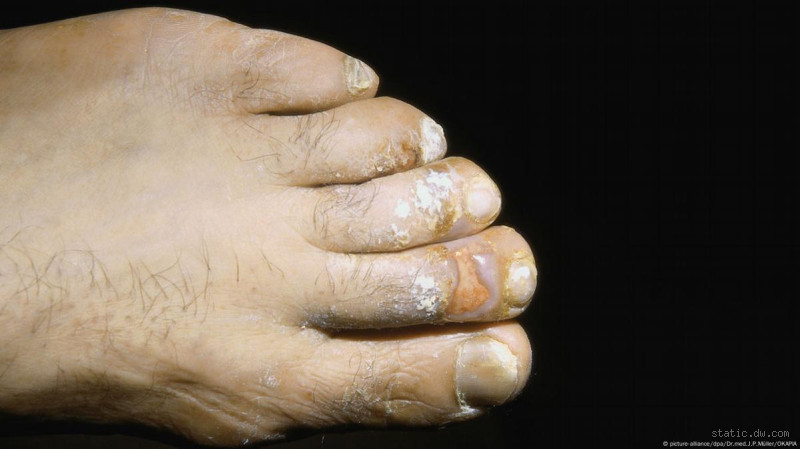 كيف اعرف ان الفطريات بدأت بالشفاء؟ علامات تدل على تحسن حالتك