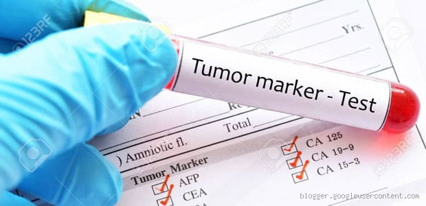 ما هو التحليل الذي يدل على وجود ورم؟ اكتشف المؤشرات وأهم الفحوصات