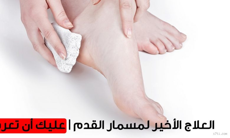 ما هو مسمار القدم؟ وكيف تتخلص منه بدون ألم؟