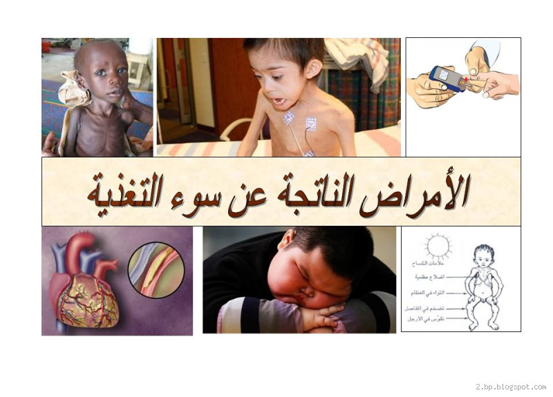 ما هي الأمراض التي تنتج عن سوء التغذية؟ تعرف على مخاطر التغذية غير السليمة