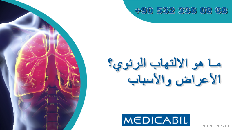 ما هي المشروبات المفيدة لالتهاب الرئة؟