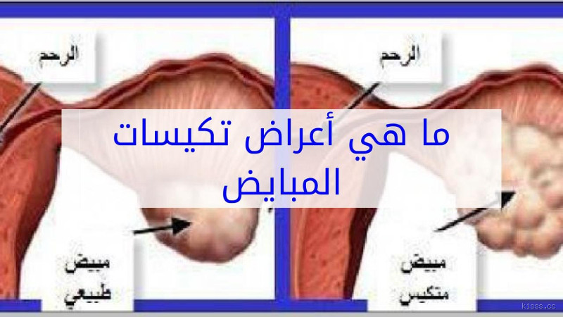ما هي علامات وجود تكيس في المبايض؟ الأعراض التي لا يجب تجاهلها