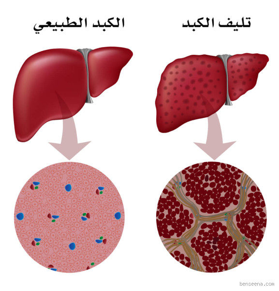 ما هي مراحل الكبد الأخيرة؟