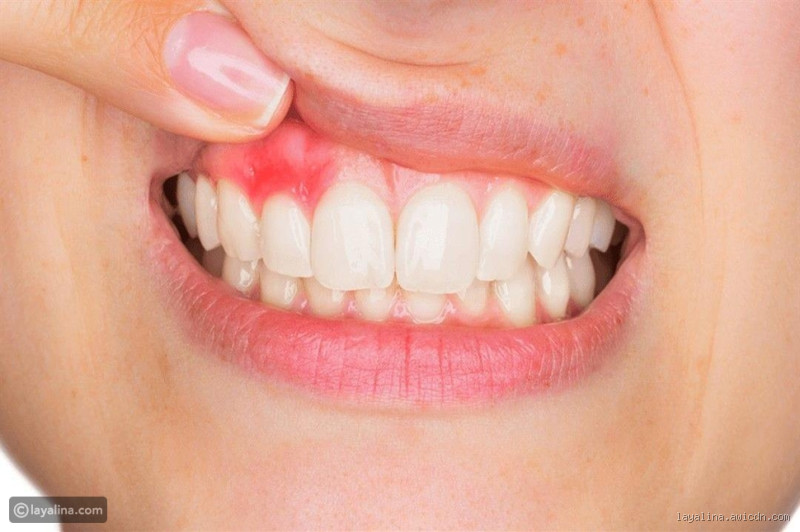 ما الفرق بين تقرحات الفم وسرطان الفم؟ وكيف تميز بينهما؟