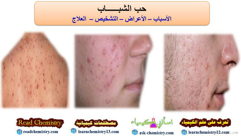 ما سبب ظهور حب الشباب على الأنف؟ تعرف على الأسباب والعلاج