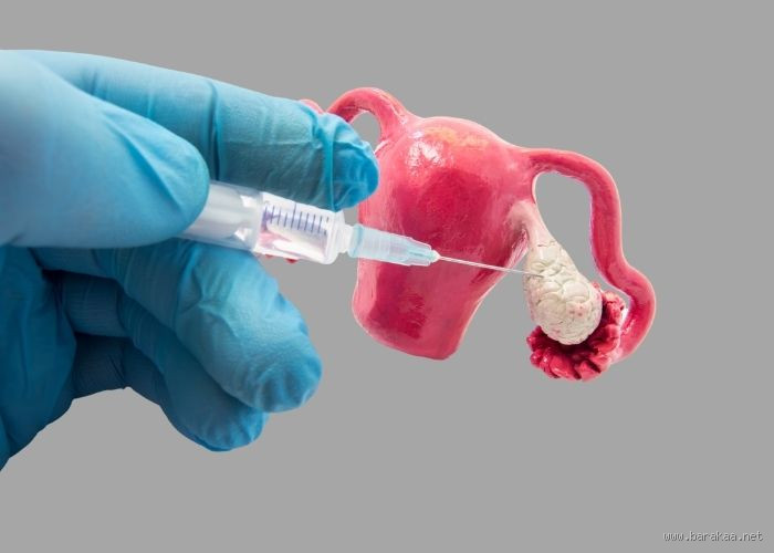 متى يستعيد المبيض نشاطه بعد الإجهاض؟ إجابة صريحة تهم كل امرأة