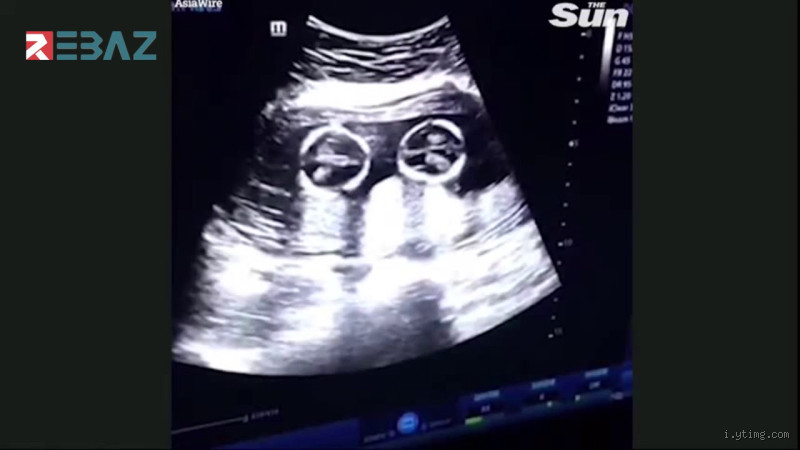 تجاربكم متى يظهر الحمل بتوأم؟